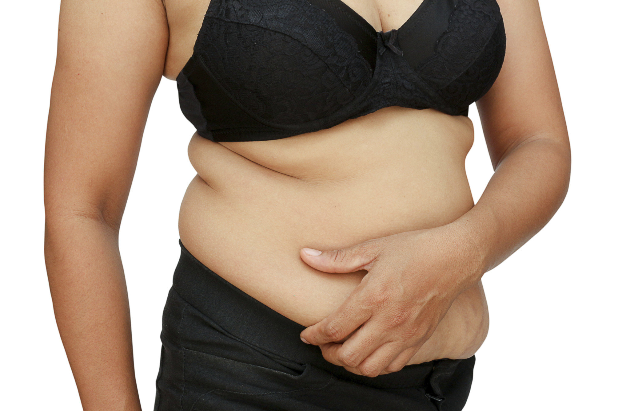 Abdominoplasty