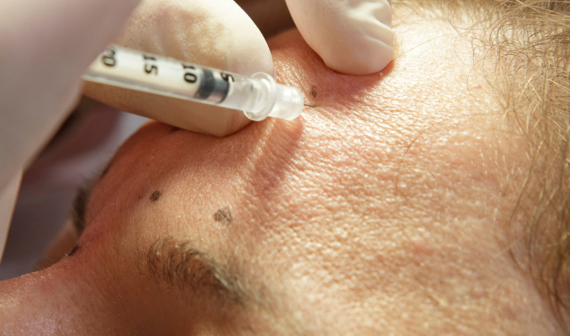 Is there a difference in Botox used for men vs. women? What does the term “Brotox” mean?