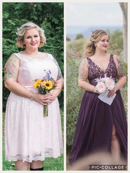 Abigail’s Experience with Breast Reduction Surgery