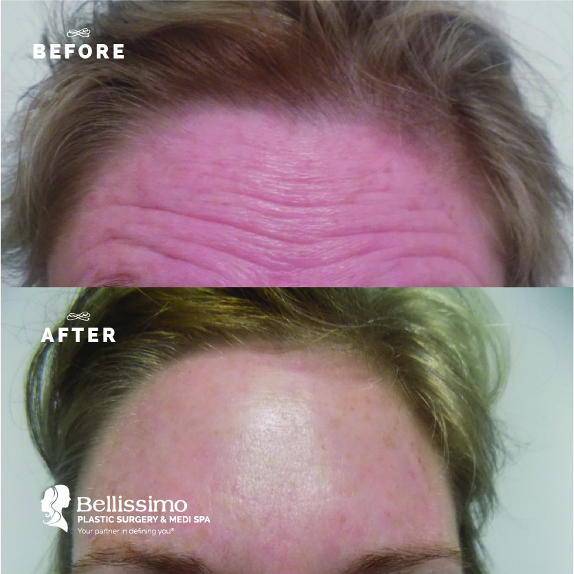 Is 2018 the year you discover Botox in Pittsburgh?