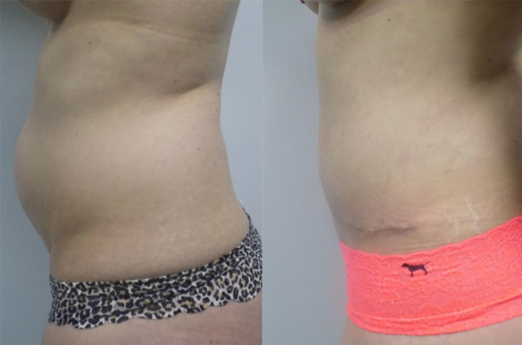 Do you have excess skin on your tummy?