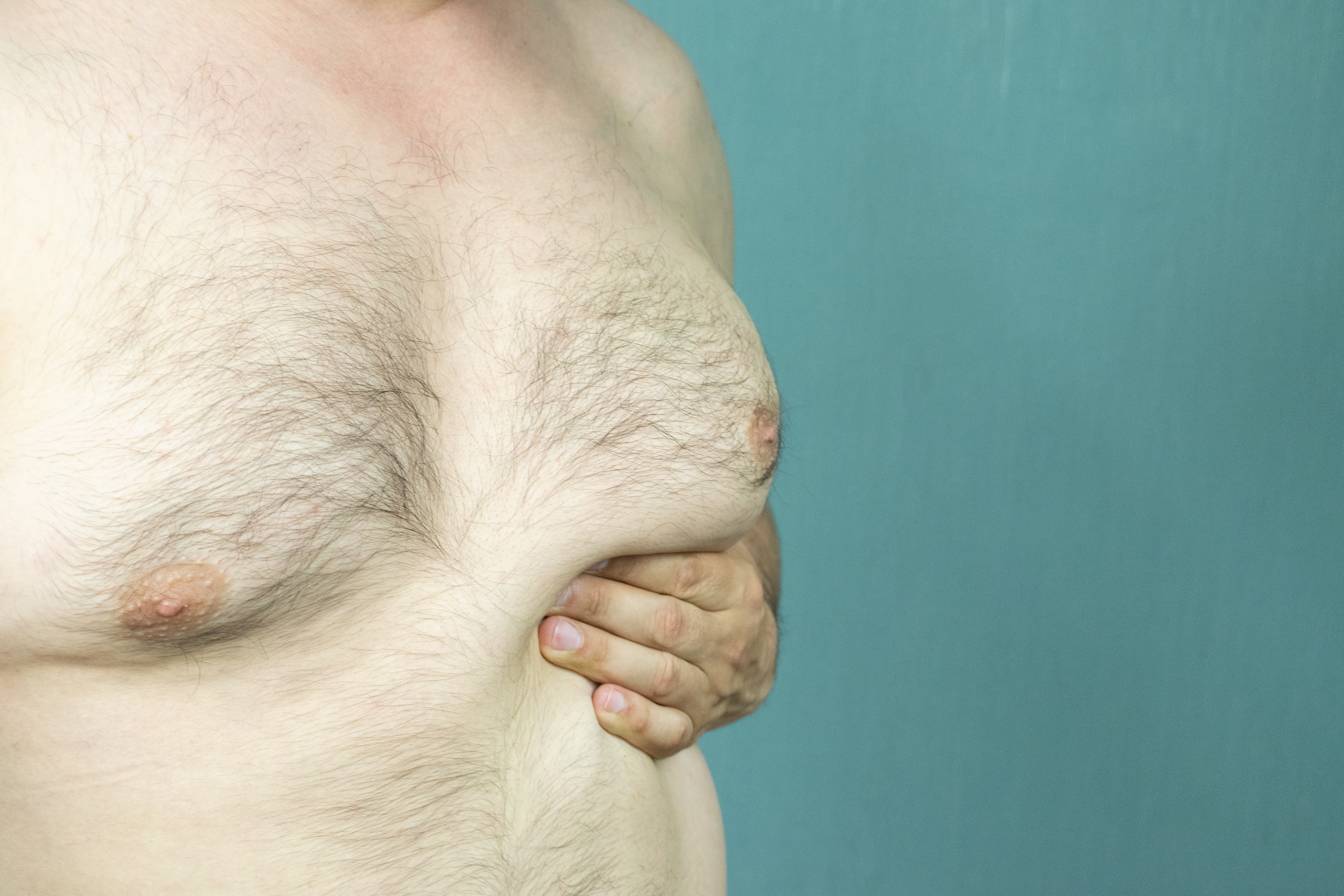 Male Breast Reduction is On the Rise