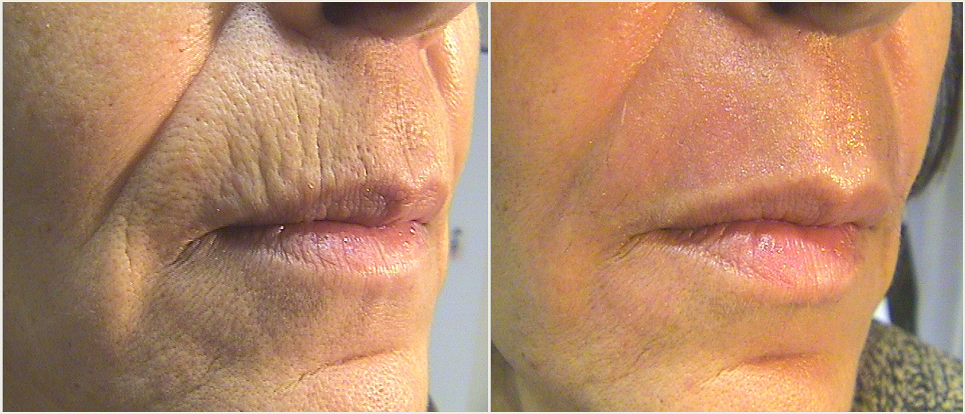 September Procedure of the Month: Tetra CO2 Laser