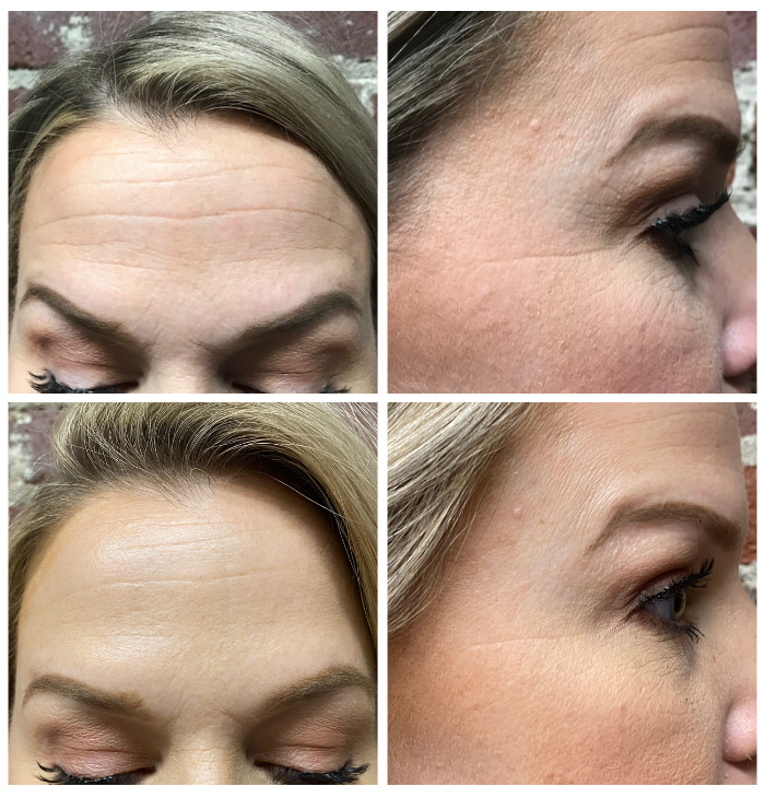 January 2020 Q & A: Eve’s Botox Experience