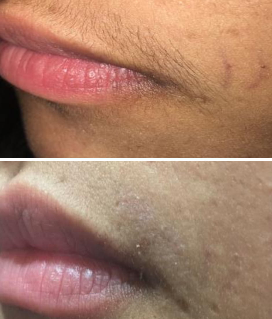 Permanent Hair Reduction, Why Wait? | Motus AX Laser Hair Removal